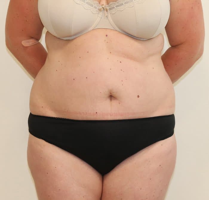Tummy Tuck (Abdominoplasty)