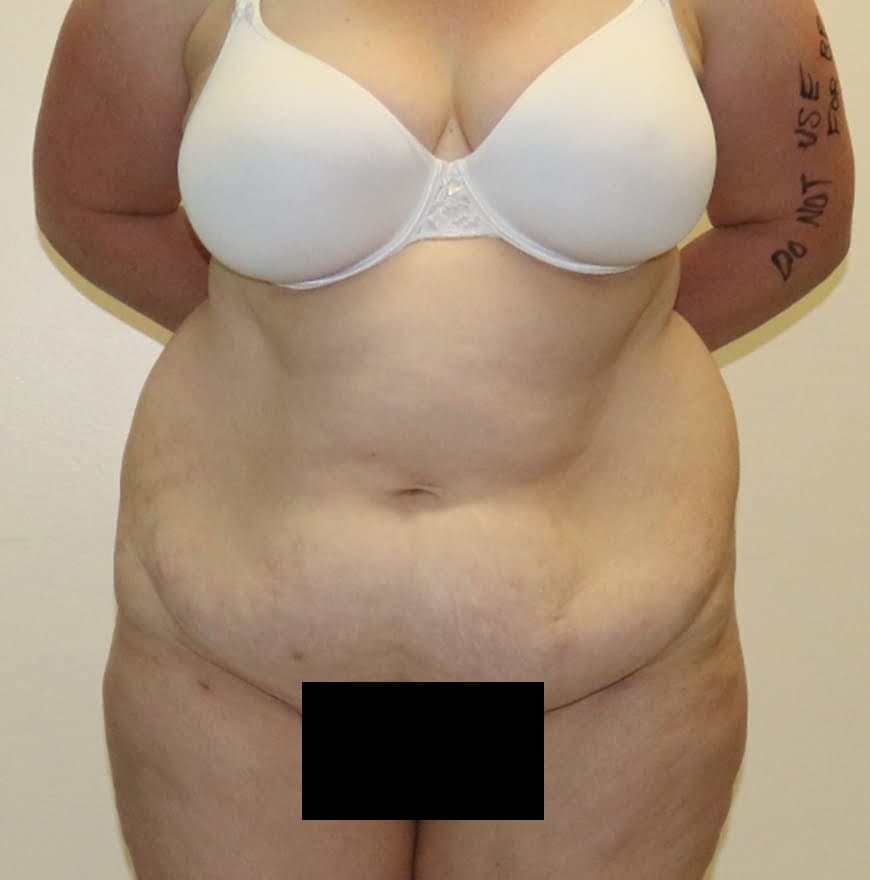 High-Lateral Tension Tummy Tuck