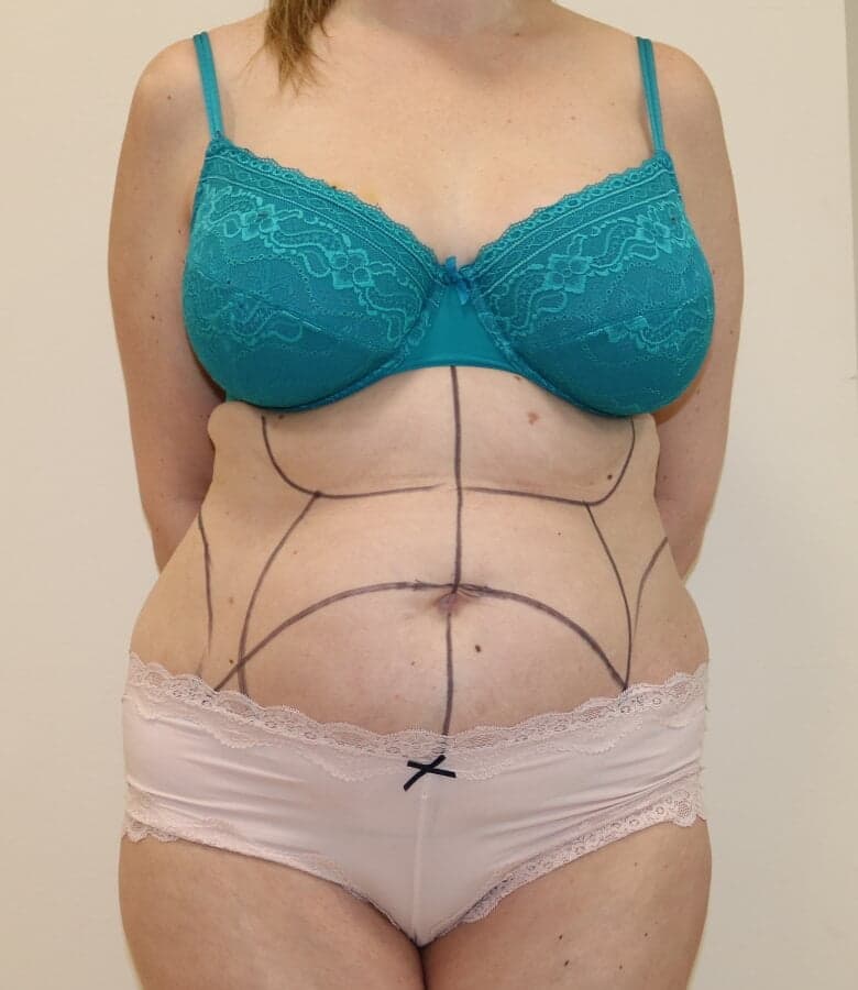 Tummy Tuck (Abdominoplasty)