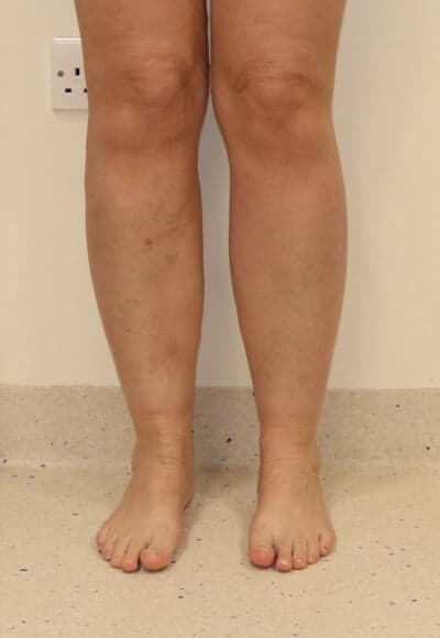 Ankle (Cankle) Contouring