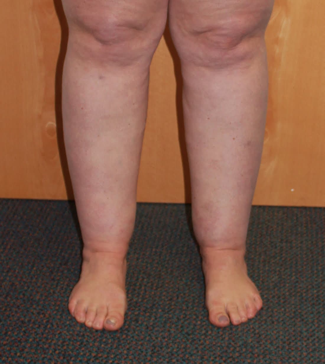 Ankle (Cankle) Contouring