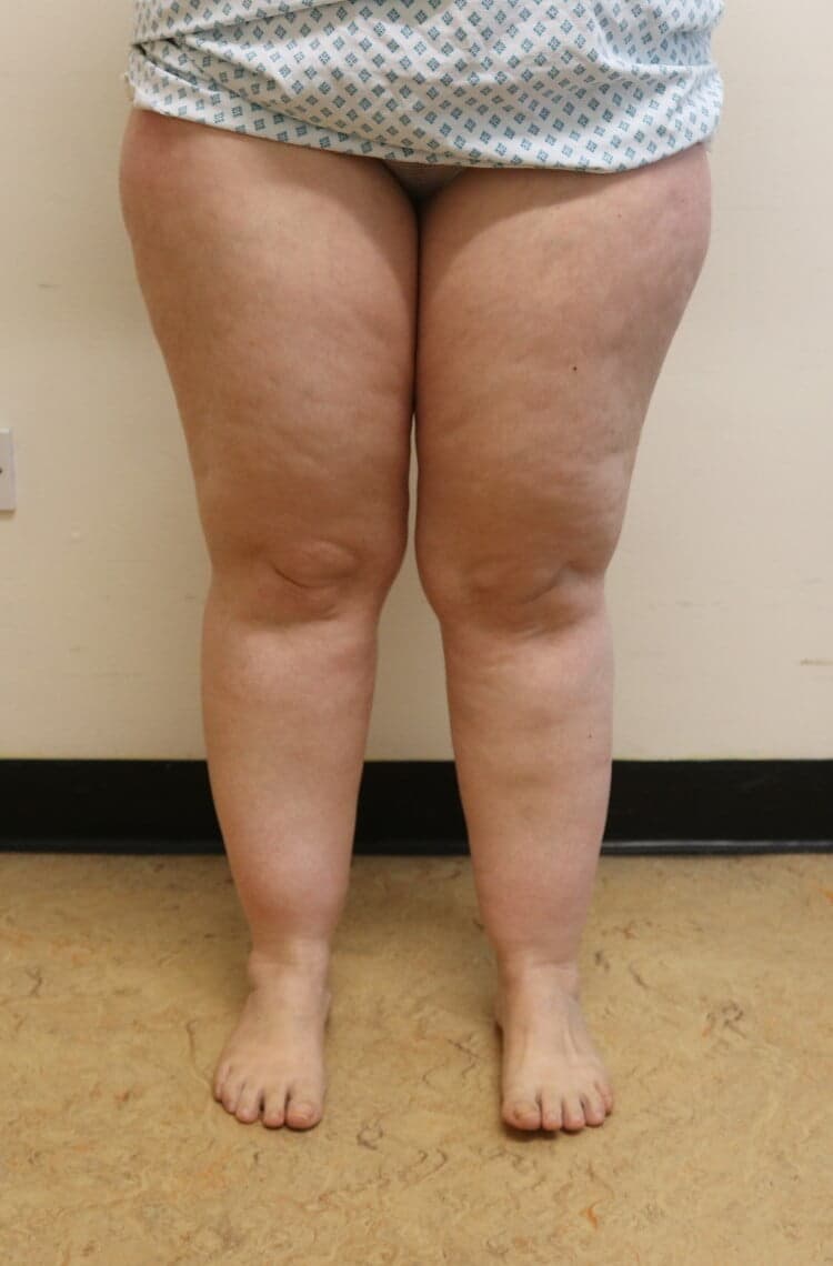 Lower Limb Lipoedema Liposuction