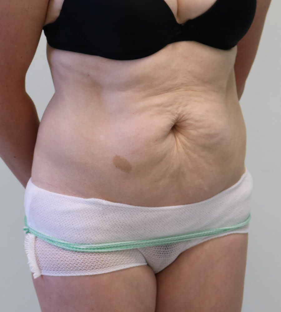 Tummy Tuck (Abdominoplasty)