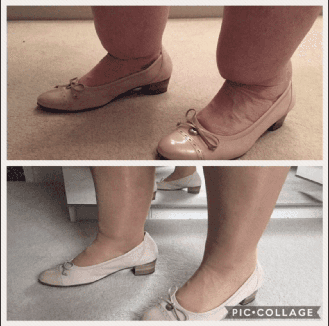 Ankle (Cankle) Contouring