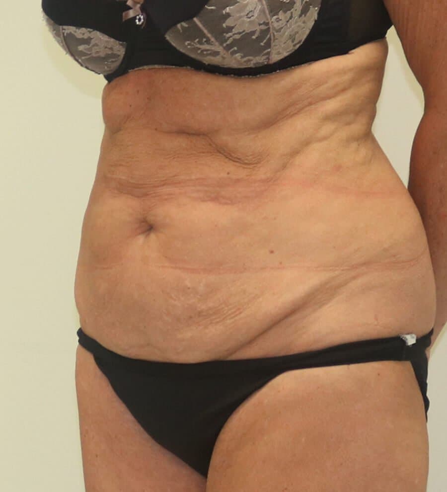 High-Lateral Tension Tummy Tuck