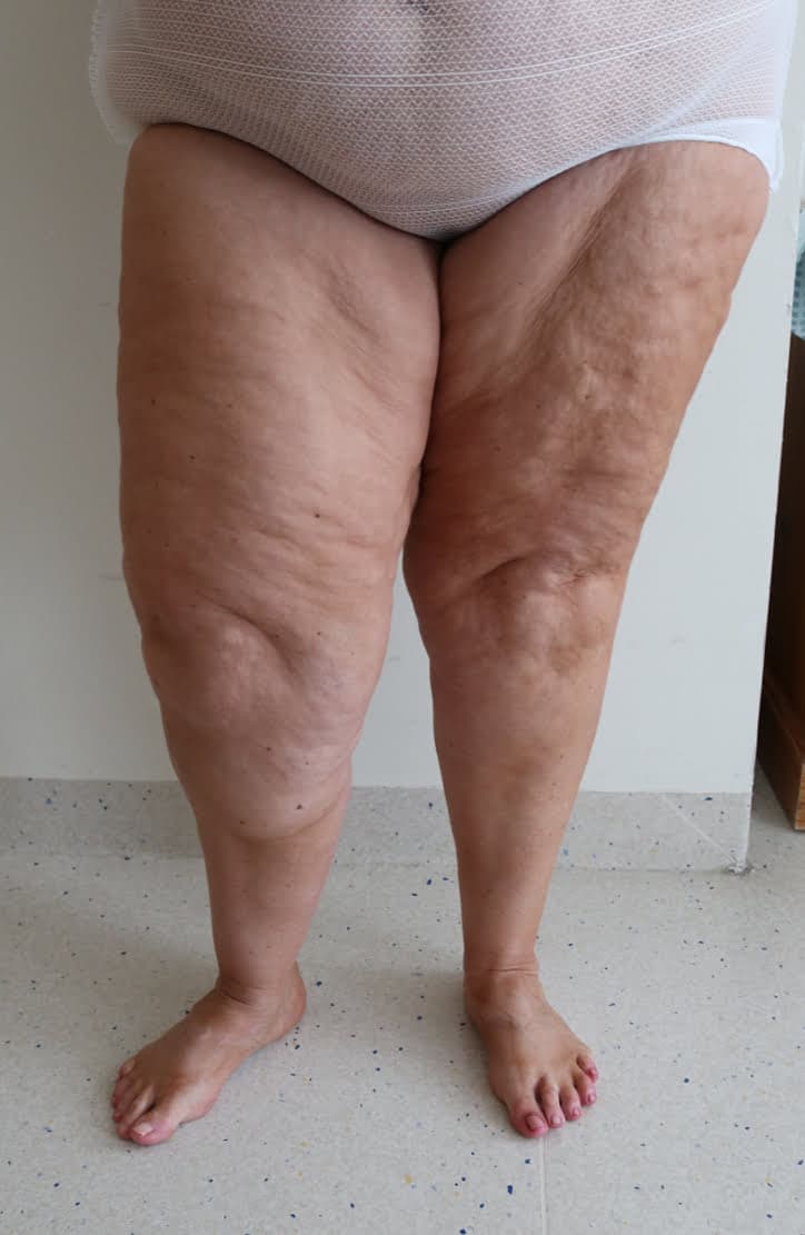 Lower Limb Lipoedema Liposuction