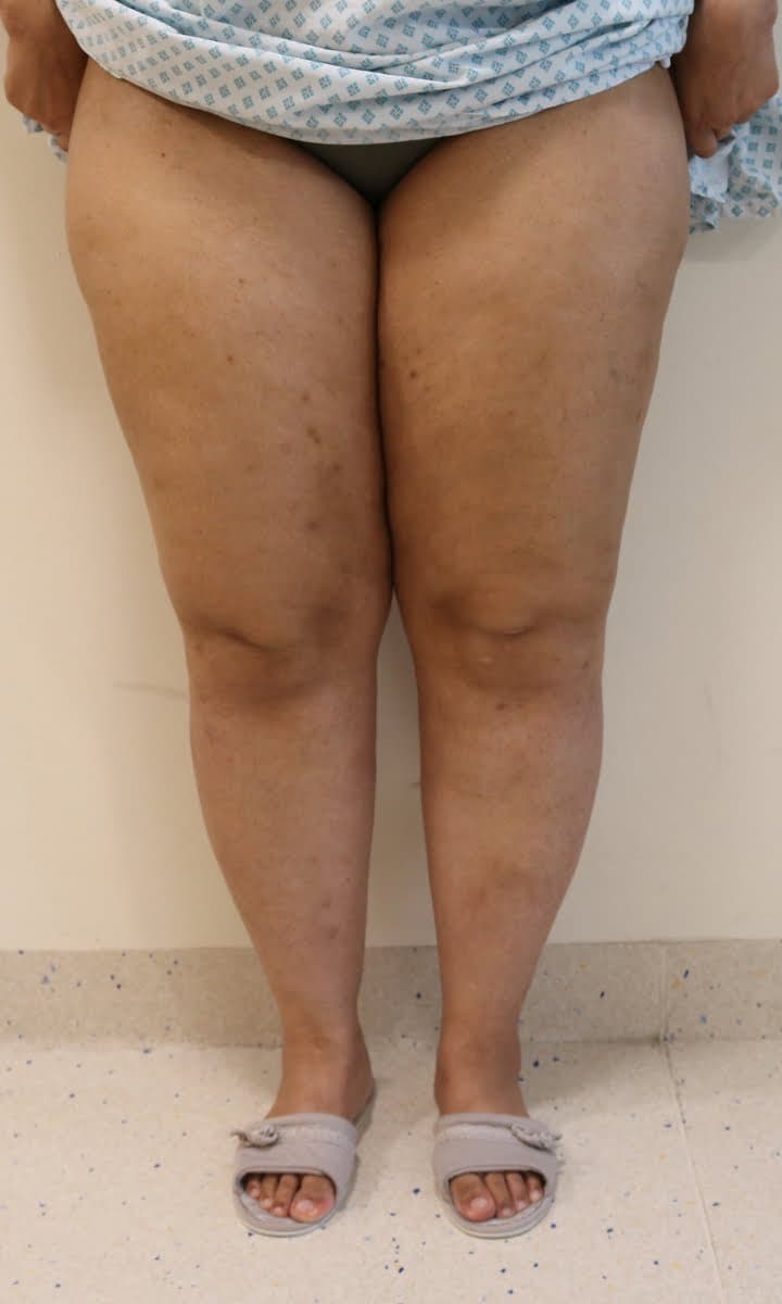 Lower Limb Lipoedema Liposuction