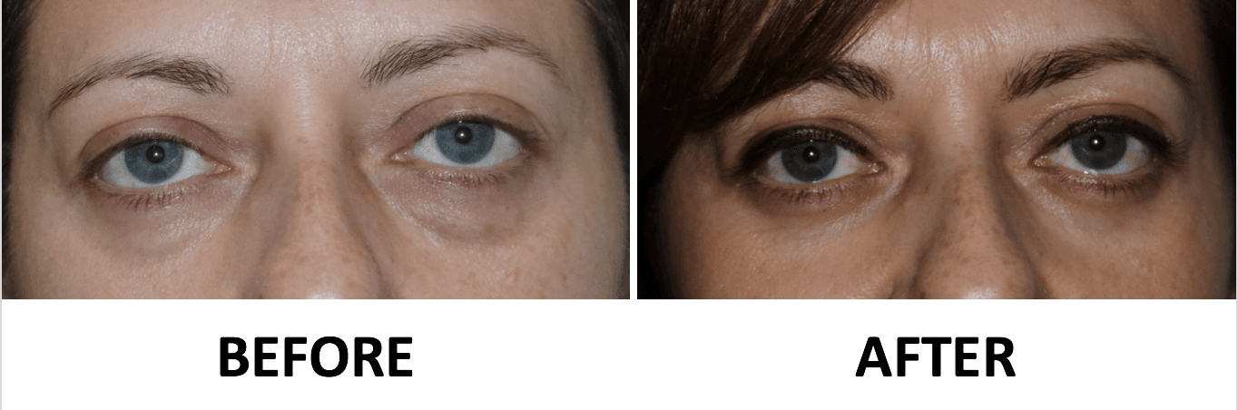 Lower Blepharoplasty