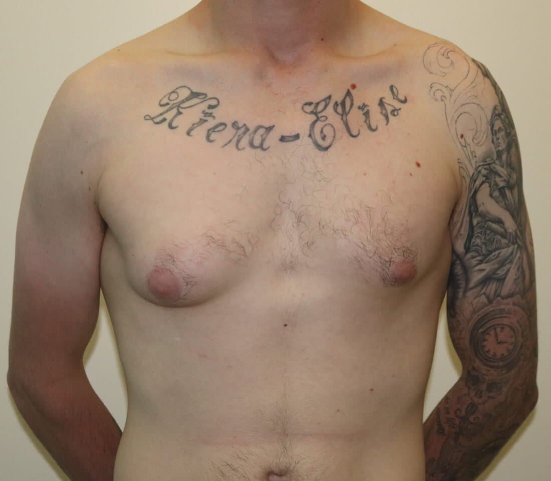 Gynaecomastia (Male Breasts) Surgery