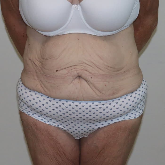 Fleur De Lis Tummy Tuck (Abdominoplasty)