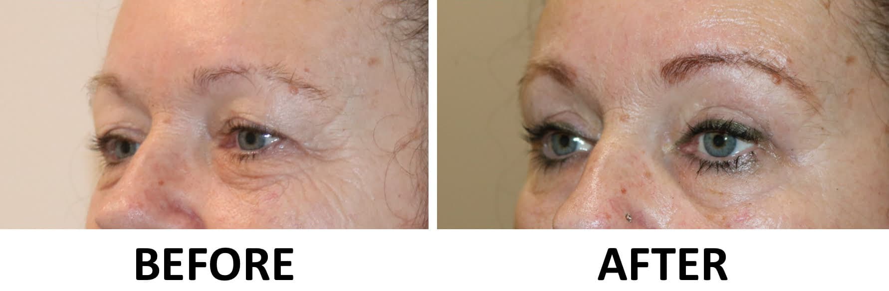Upper Blepharoplasty