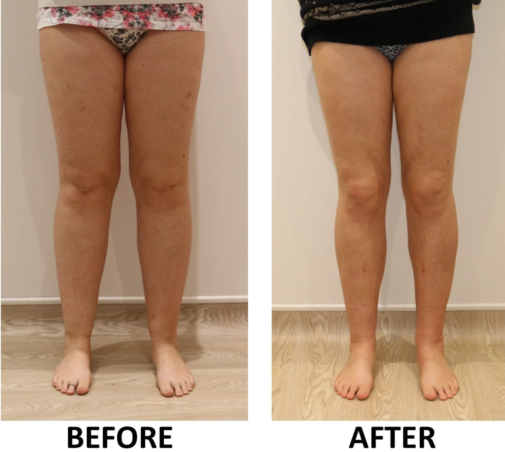 Lower limb liposculpture