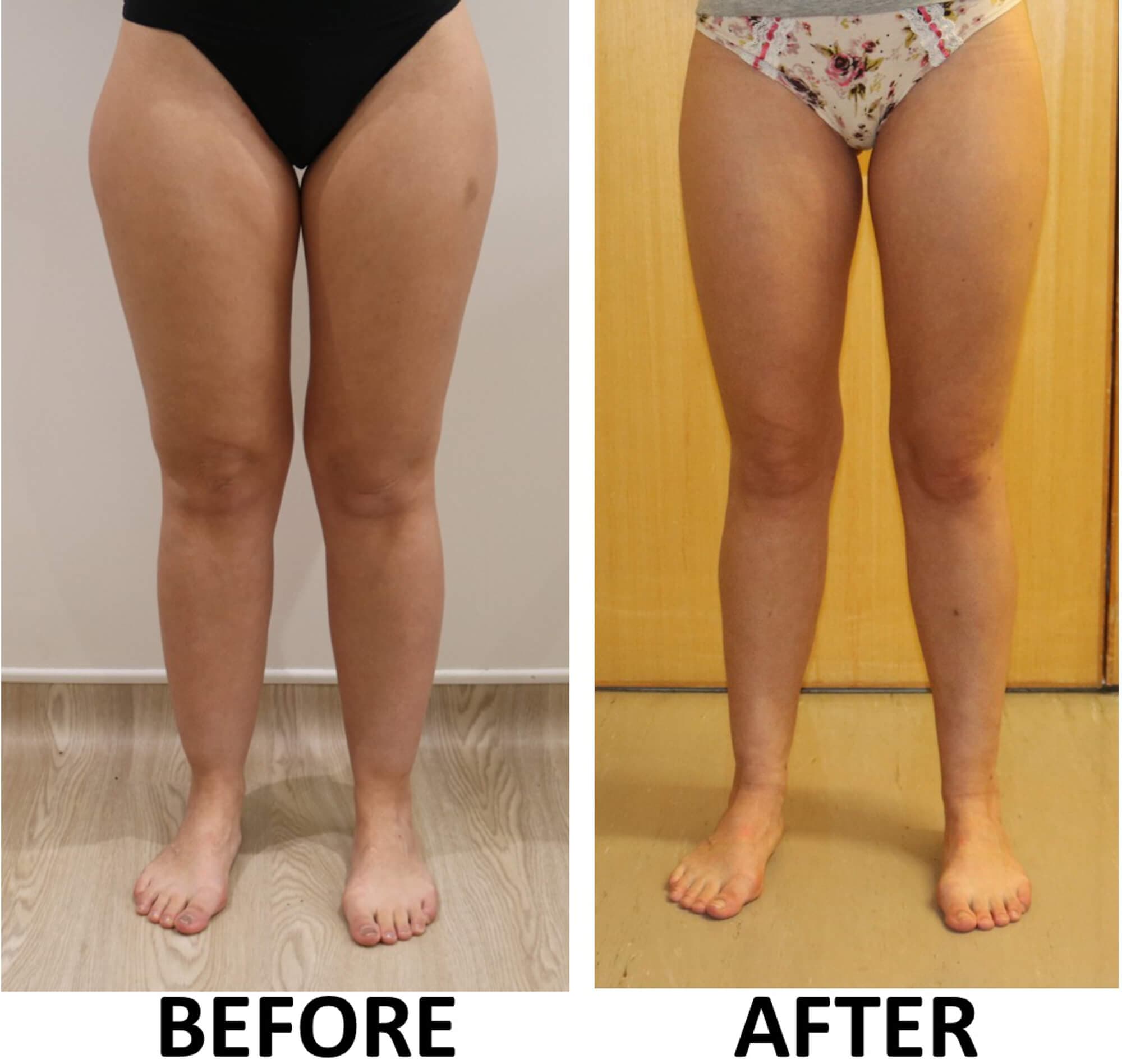 Lower limb liposculpture