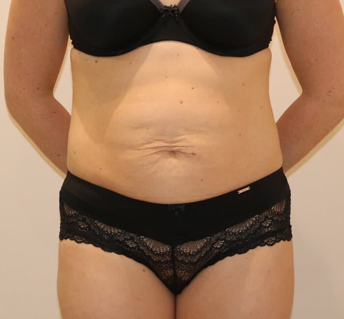 Tummy Tuck (Abdominoplasty)