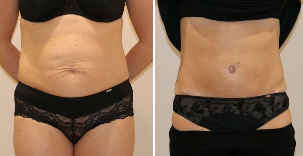 Tummy Tuck Daycase at The Karri Clinic