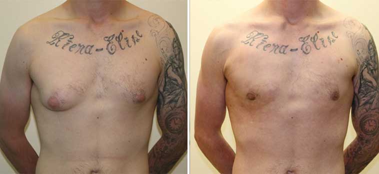 Unique Gynaecomastia (Male Breast) Surgery Using the Invisible Scar Technique at The Karri Clinic