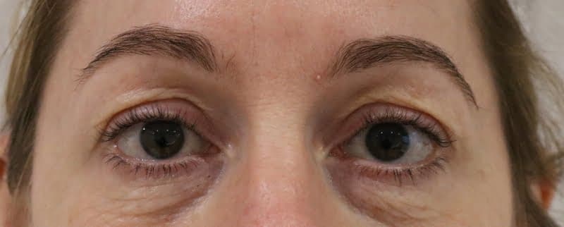 Upper Blepharoplasty