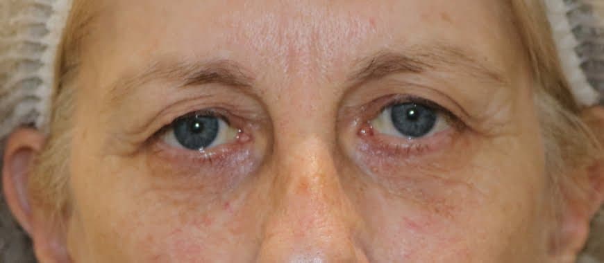 Upper Blepharoplasty