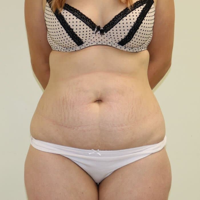 Tummy Tuck (Abdominoplasty)