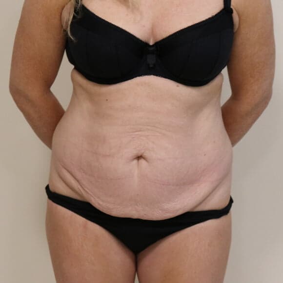 Tummy Tuck (Abdominoplasty)