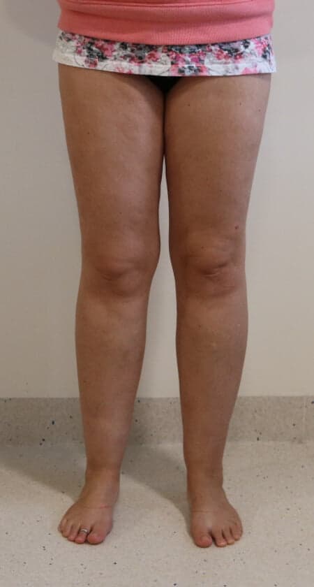 Lower Limb Lipoedema Liposuction