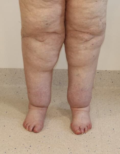 Lower Limb Lipoedema Liposuction