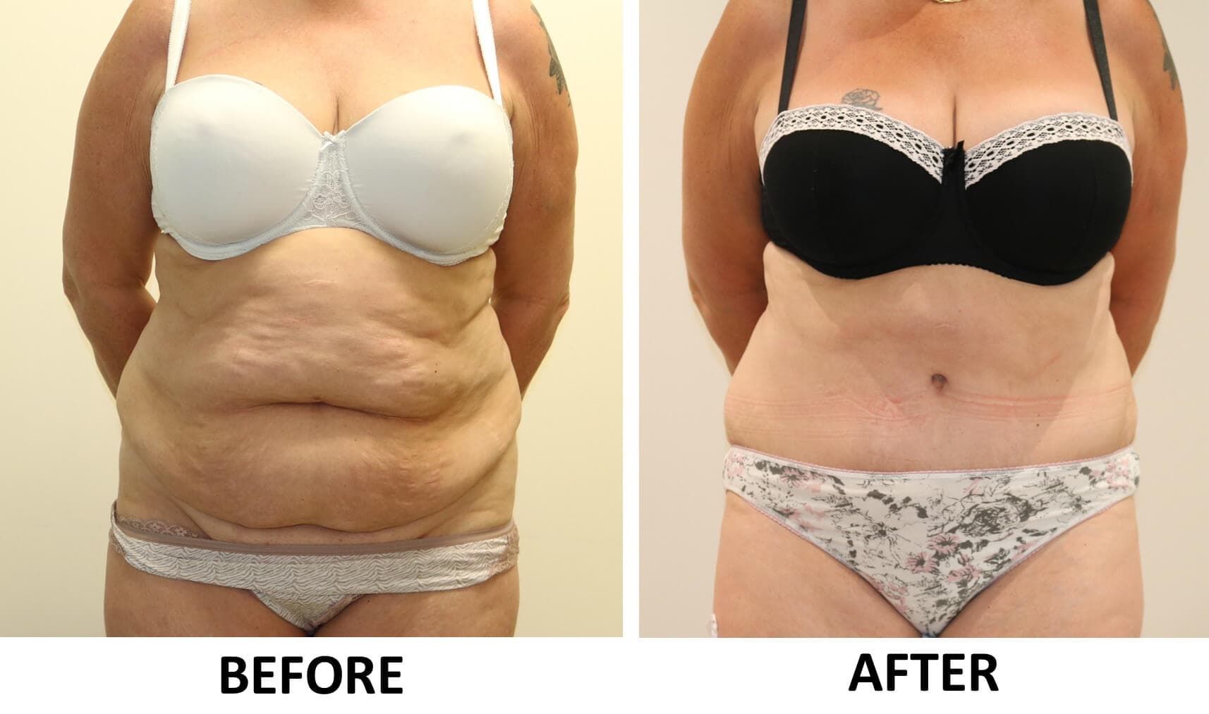 Tummy Tuck (Abdominoplasty)