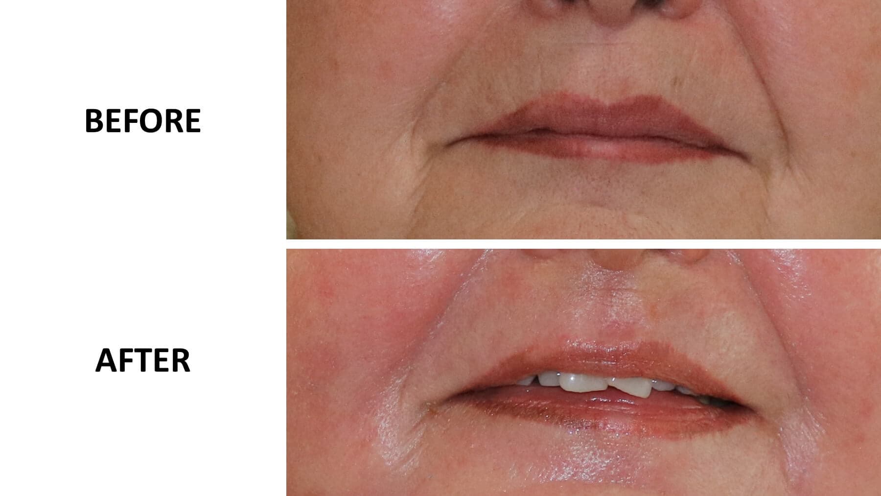 Phenol Peel