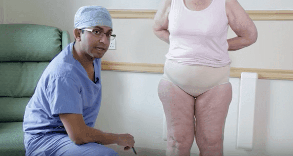 WATCH: Mr Karri explains the characteristics of lipoedema, plus live WAL surgery