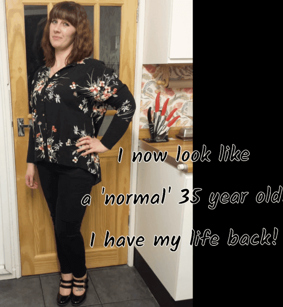 WATCH: Life With Lipoedema - Hannah's Story...