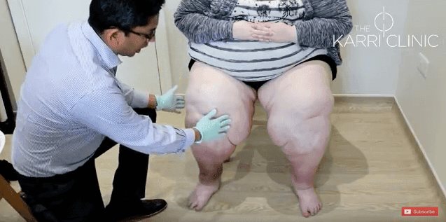 30 Facts About Lipoedema for Lipoedema Awareness Month