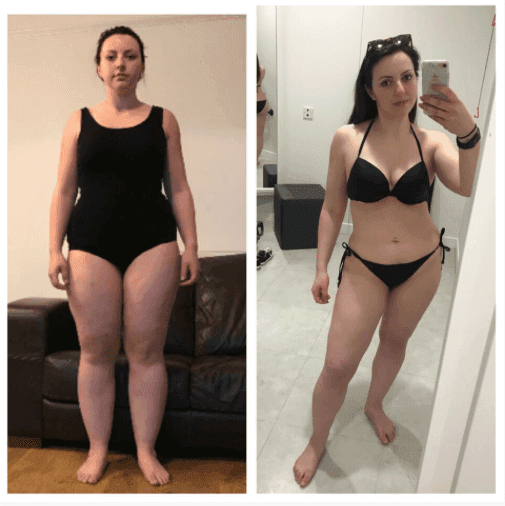 Surgery Day, Before & Afters, Pre Surgery Videos & the Aftermath - Hollie's Lipoedema Journey