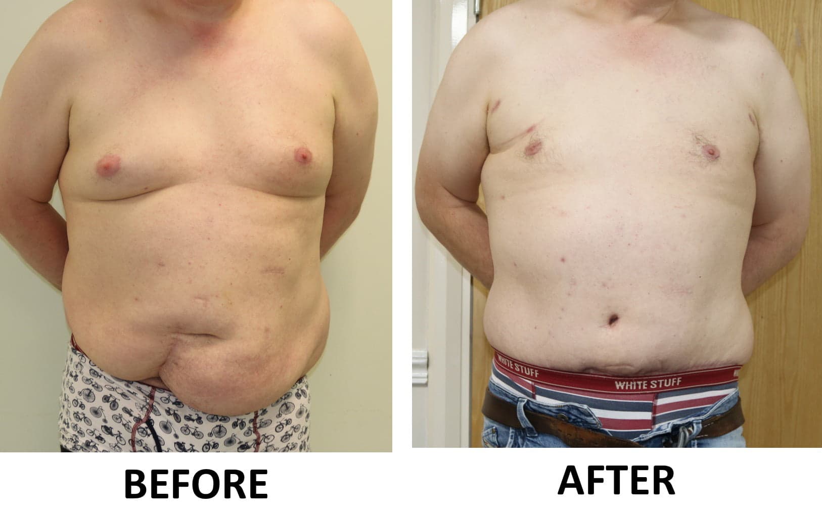 Tummy Tuck (Abdominoplasty) & Male Breast Reduction