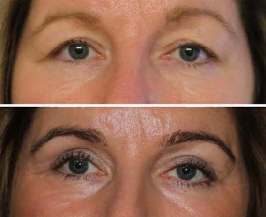Before and After - Upper Blepharoplasty & Lower Eyelid Phenol Peel