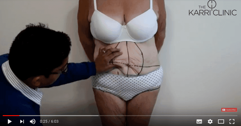LIVE SURGERY | Fleur de LIs Tummy Tuck by Mr Vasu Karri