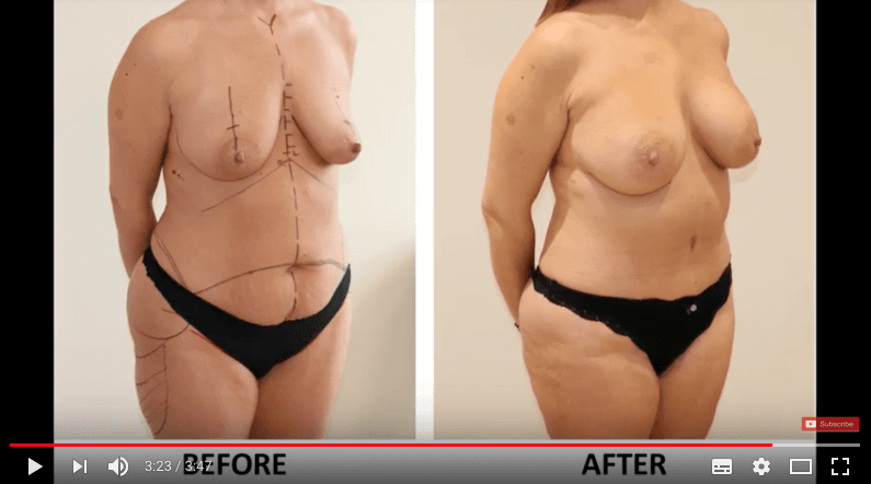Mummy Makeover Breast Enlargement & Brazilian Tummy Tuck | Before & After Photos