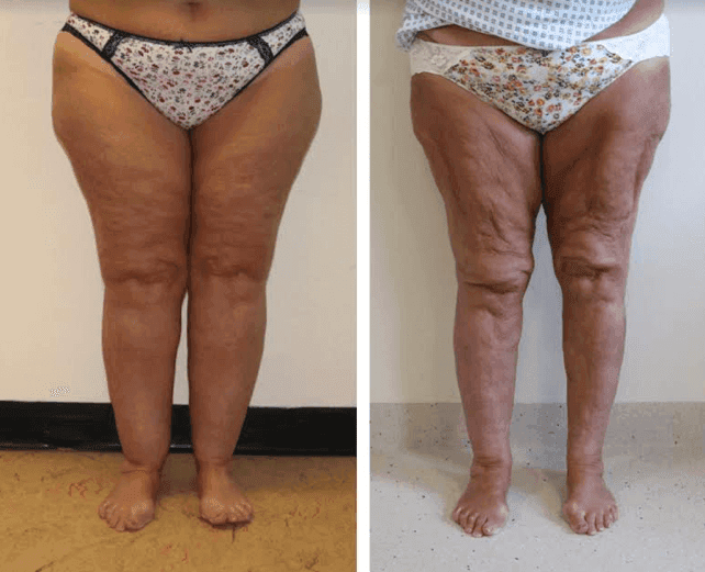 Lower limb lipoedema liposuction - 11.8 litres of fat removed