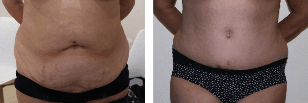 Brazilian Tummy Tuck - Before and After