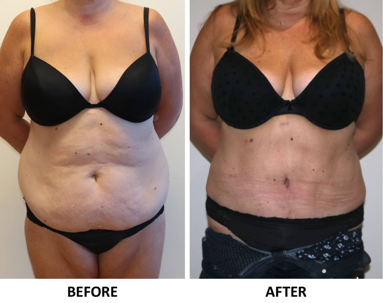 Tummy Tuck (Abdominoplasty)
