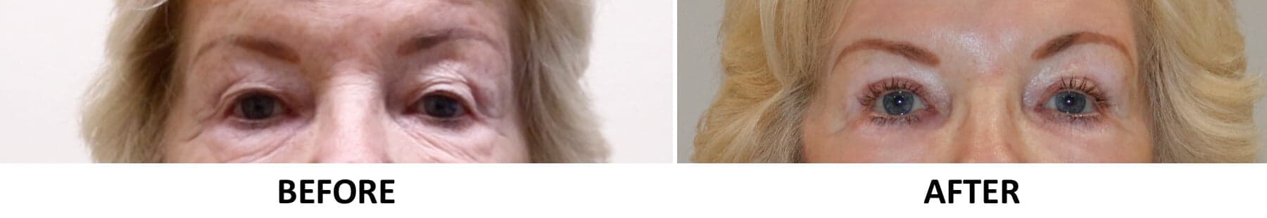 Direct Brow Lift & Upper Blepharoplasty