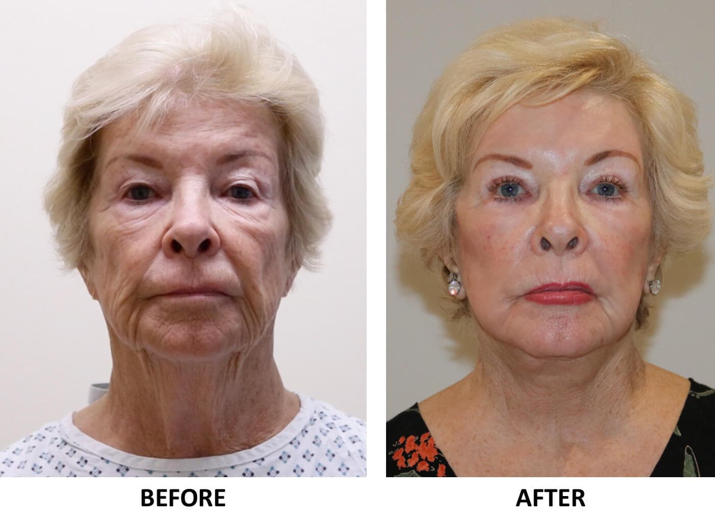 Facelift