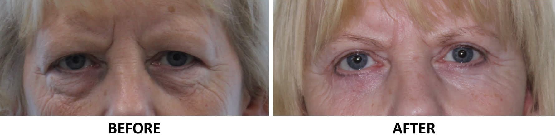Upper & Lower Blepharoplasty