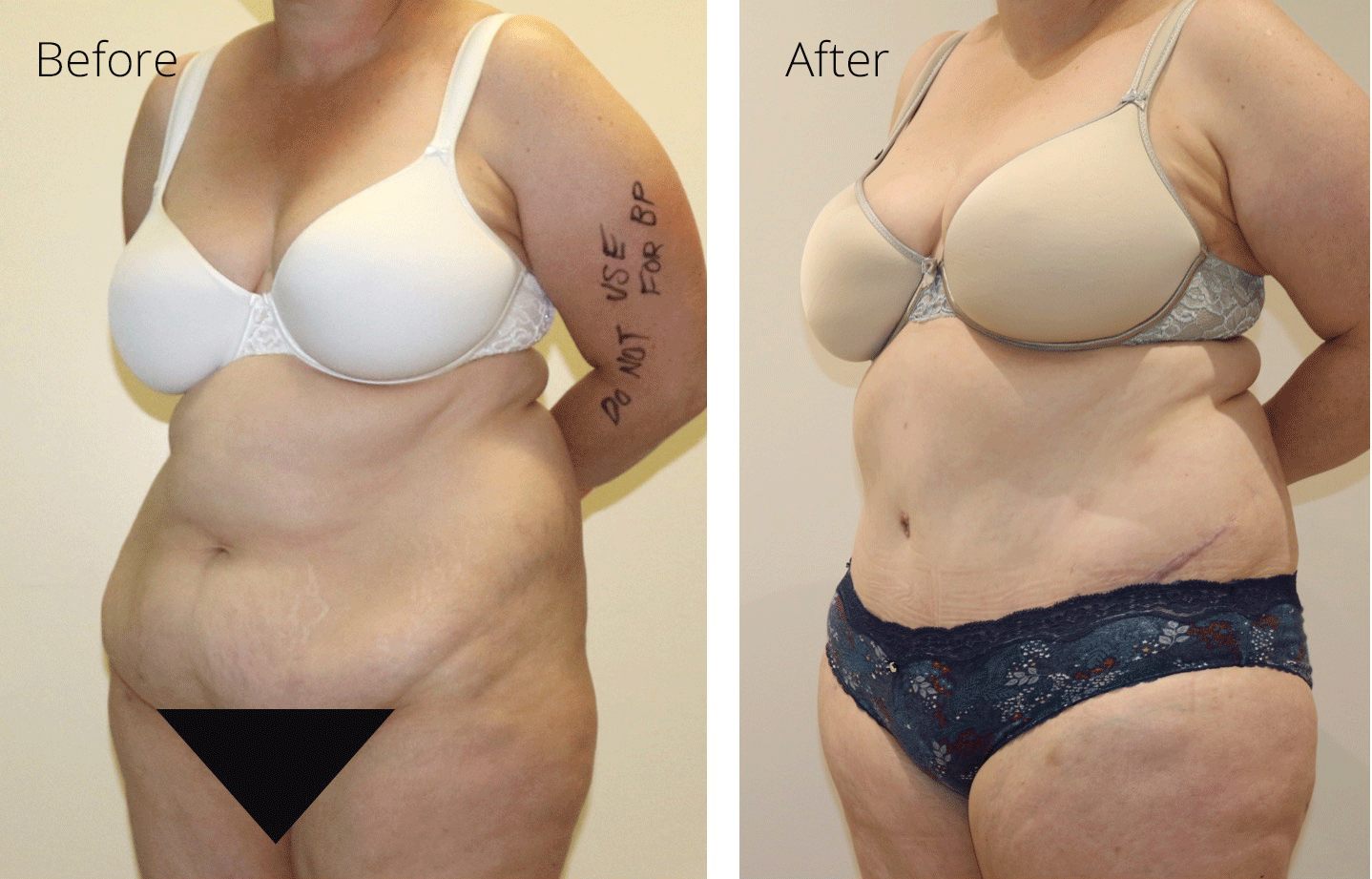 Before and After A Brazilian Tummy Tuck