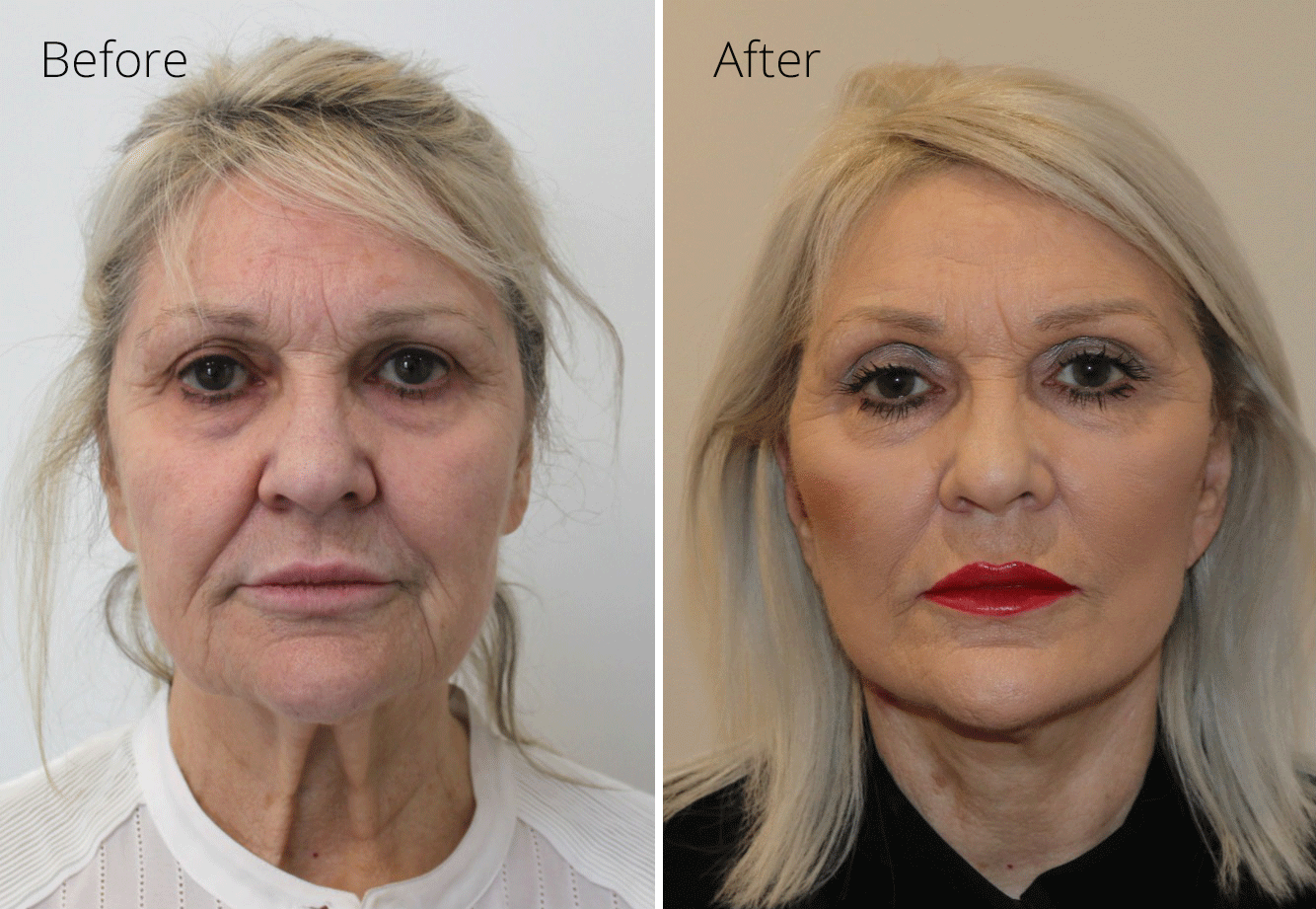 Facelift & Neck lift Performed under Sedation Anaesthesia