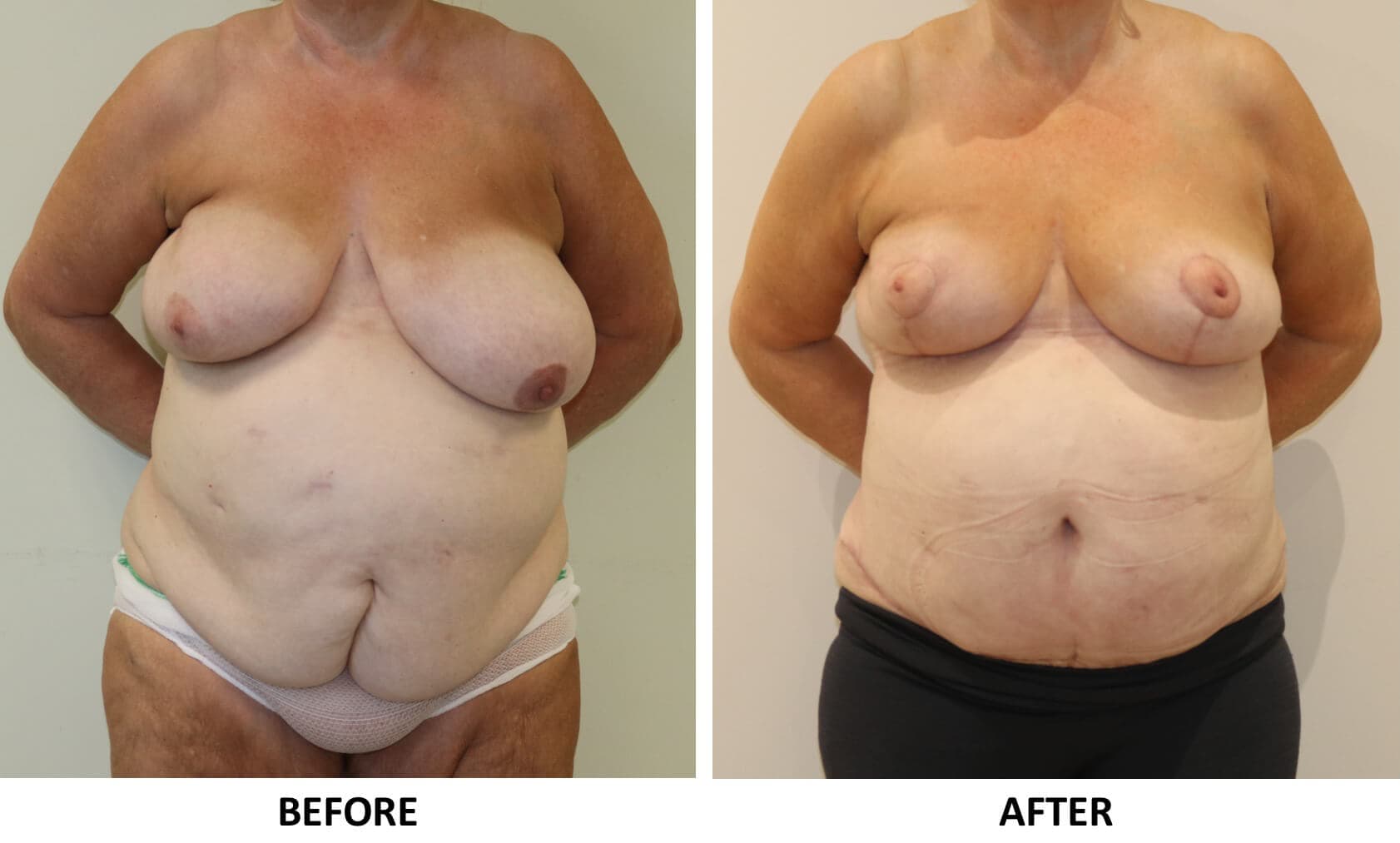 Breast Reduction