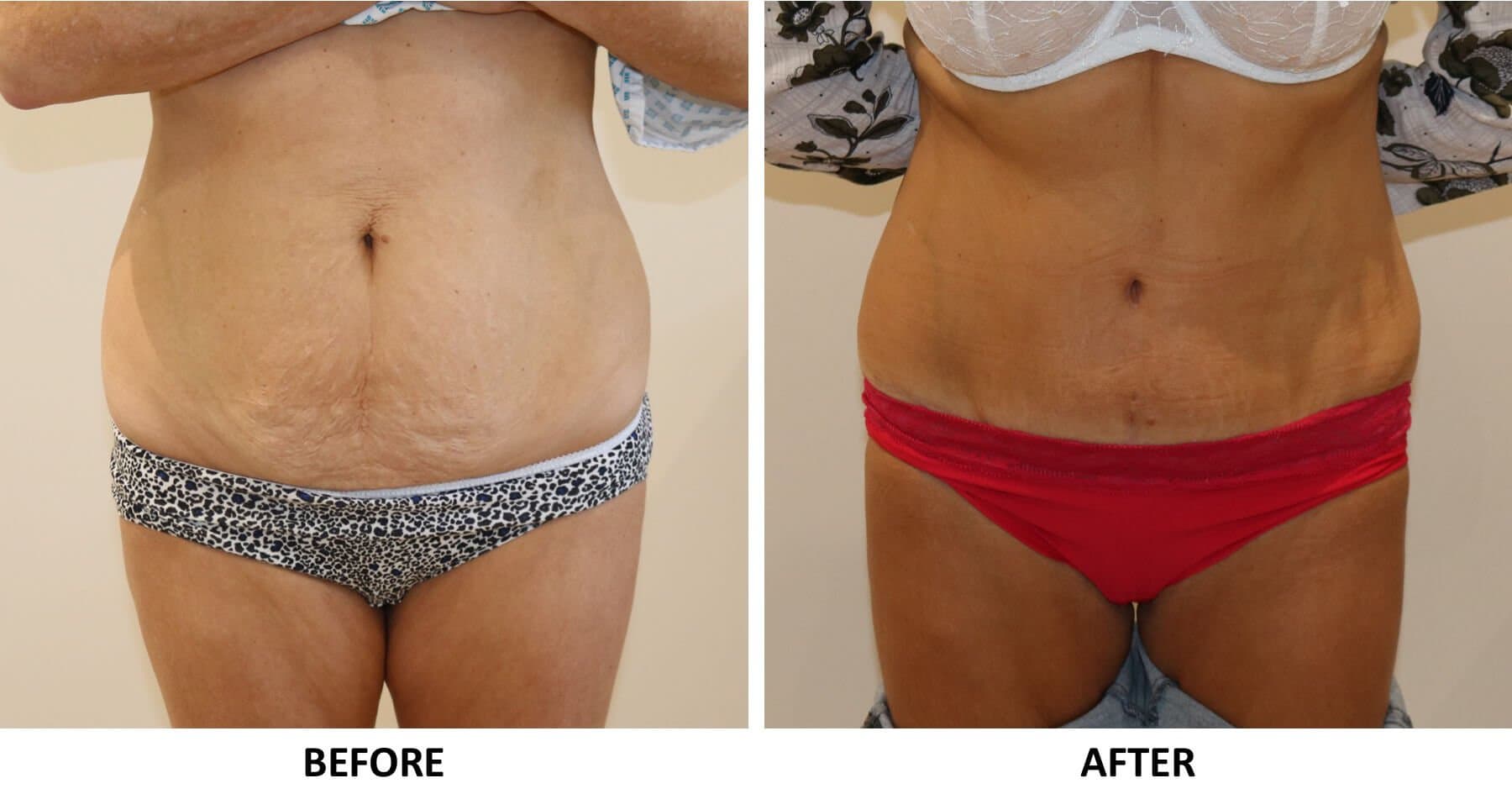 Tummy Tuck (Abdominoplasty)