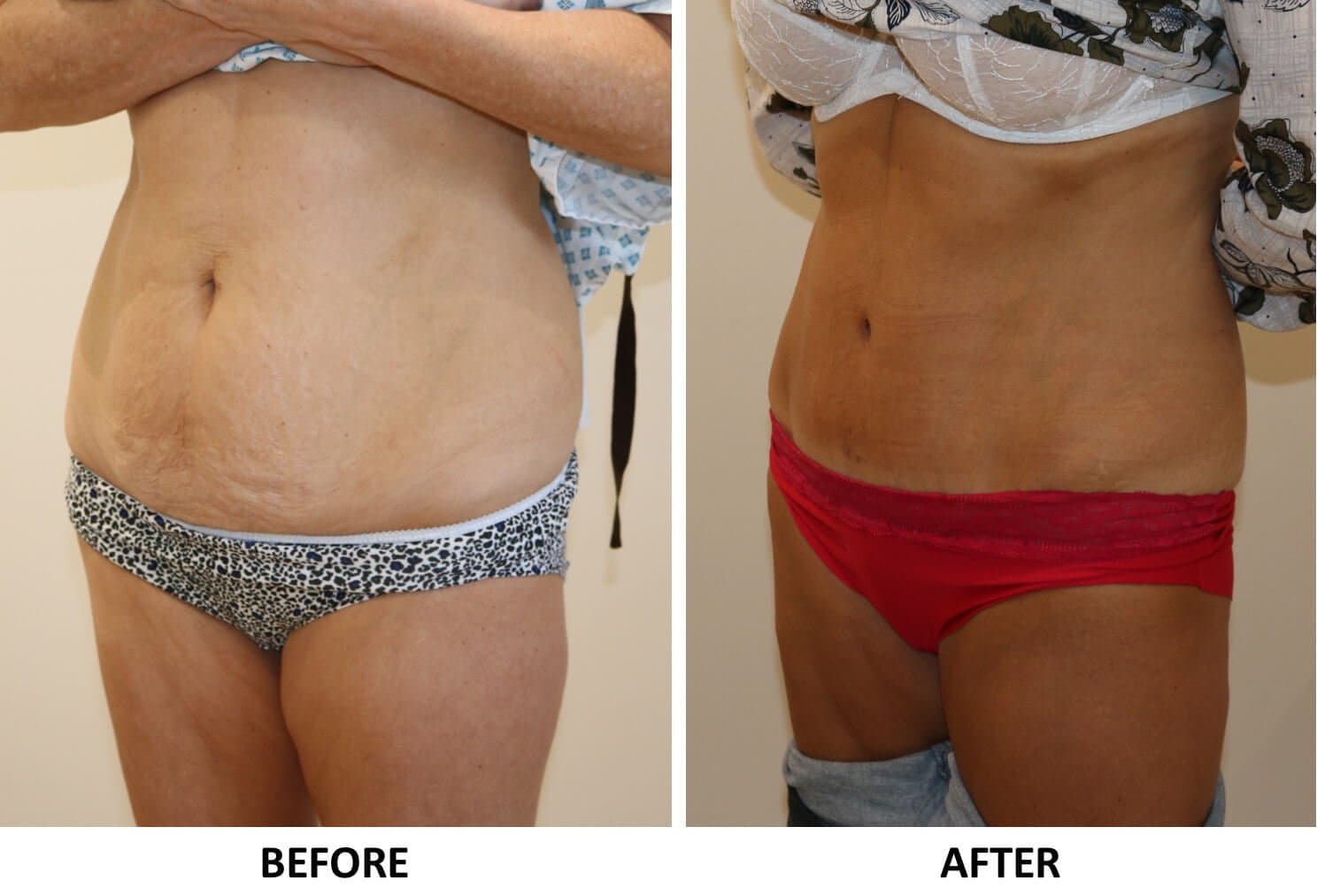 Before & After: A Post Childbirth Tummy Tuck Surgery