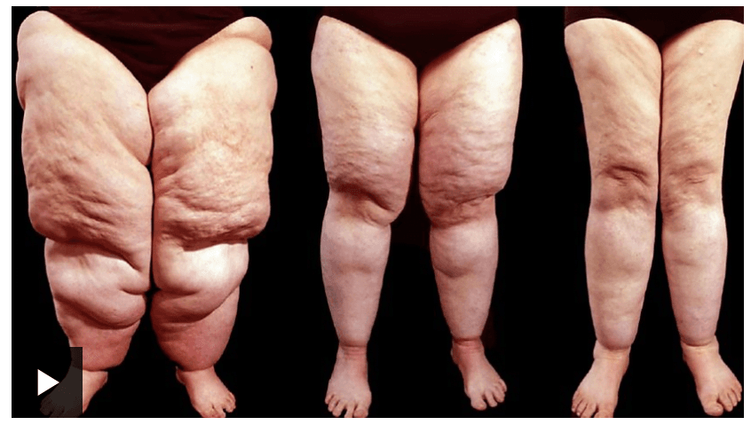 WATCH: BBC Lipoedema Feature