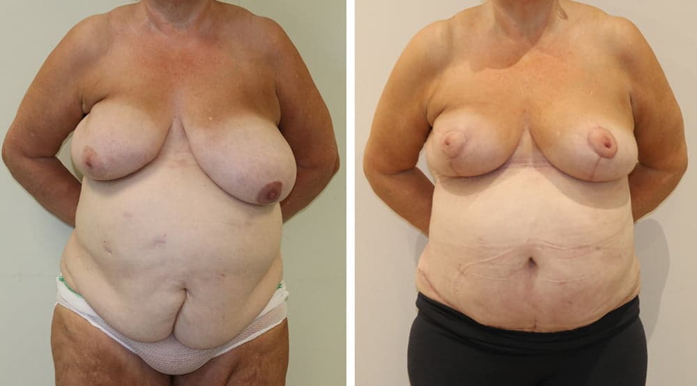 Symmetrising Breast Reduction Following Cancer Surgery & Brazilian Tummy Tuck