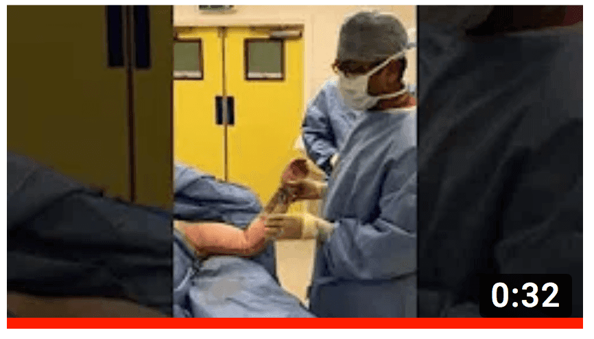 WATCH: Pre Op, Post Op and Recovery - Brachioplasty (Arm Lift)